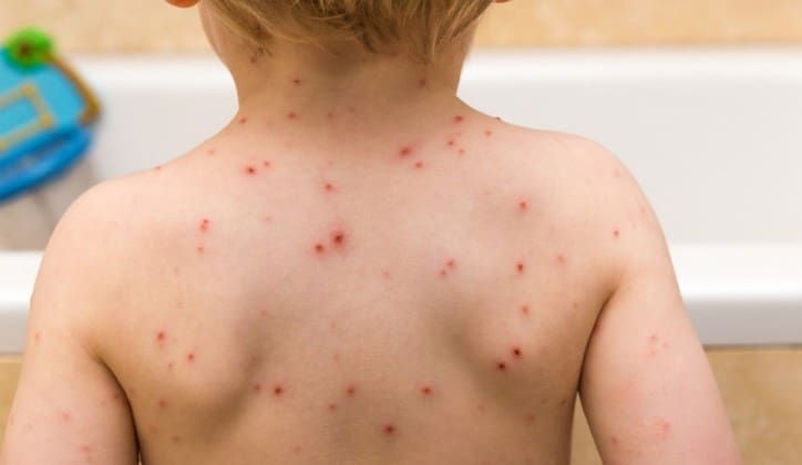 Male boginje u Srbiji, oboljelo šest nevakcinisanih osoba, najviše djece