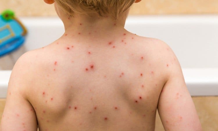Epidemija se ubrzano širi: Od morbila u FBiH oboljelo više od 1.500 osoba
