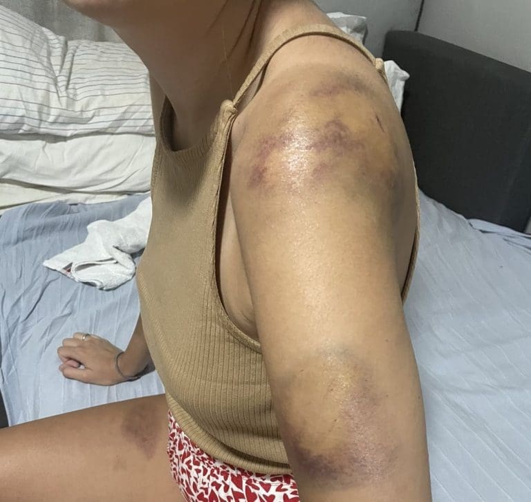 Ivani je grad napravio modrice po cijelom tijelu: “Mislila sam da neću preživjeti”