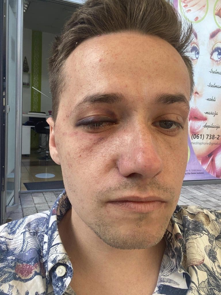 Mladić tvrdi da ga je zenička policija pretukla i satima mučila bez razloga, MUP kaže da se opirao privođenju