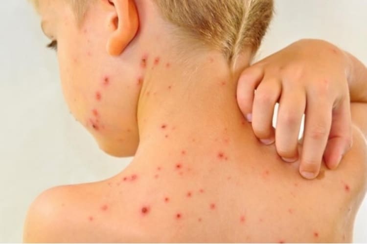 Morbilima zaraženo 311 lica, najviše u Bijeljini