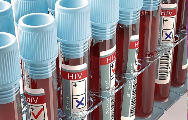Novi podaci otkrivaju slabosti u odgovoru BiH na HIV epidemiju
